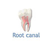 Root Canal